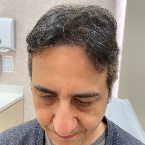 Rupinder Rekh: 8 Months into Hair Treatment