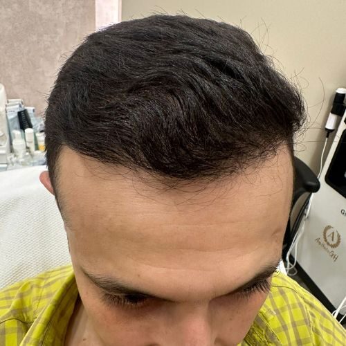 Raymond Shroff: 8 Months into Hair Treatment