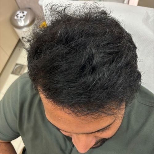 Roshan Shetty: 8 Months into Hair Treatment