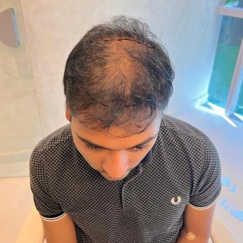 Karan Suresh Before Hair Tansplant Surgery
