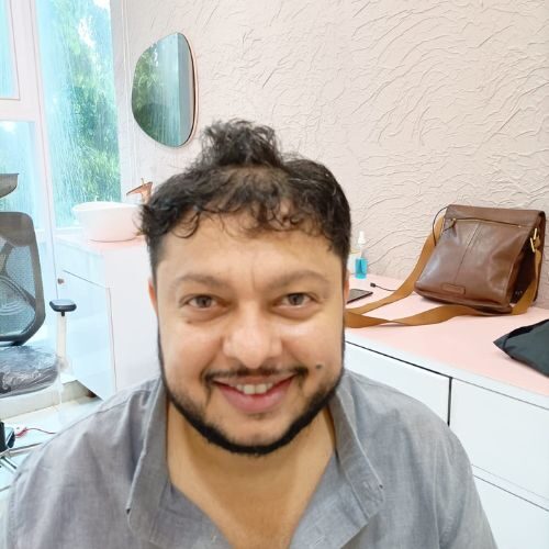Sourabh Khotari Before Hair Tansplant Surgery
