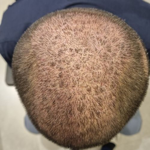 Clot Removal Sourabh Khotari