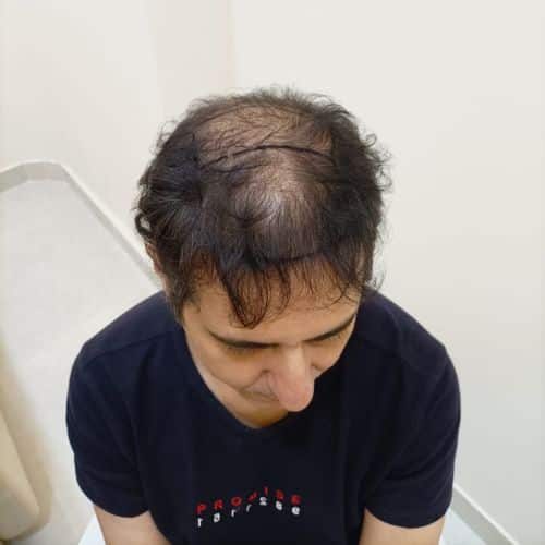 Rupinder Rekh Before Hair Tansplant Surgery