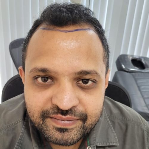 Roshan Sheety Before Hair Transplant